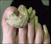 Custy tose 
