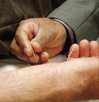 Acupuncture