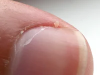 Hangnail
