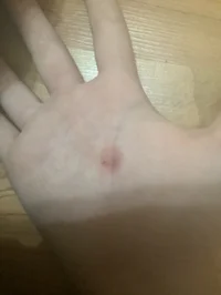 Blister in hand