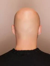 Bald head