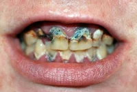 Your teeth