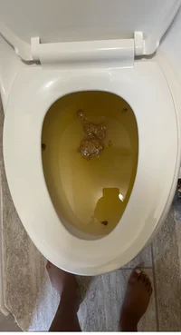 Diarrhea 