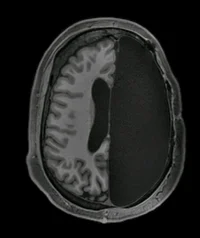 hemispherectomy