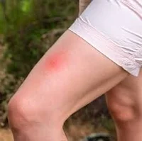 Bug bite thighs