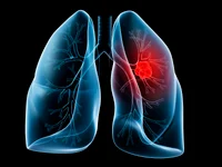 Lung Cancer