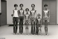 Malnourished Family