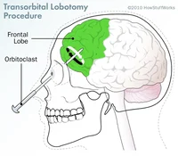Lobotomy