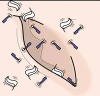 Navel micro invasion