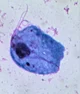 T Vaginalis