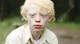 Albinism Boy