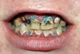 Your teeth