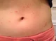 Bug bite stomach