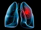 Lung Cancer