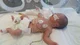 Premature baby