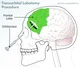 Lobotomy
