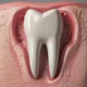 Cavity Tooth